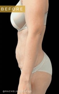Before Image: Case #6722 – Abdominoplasty - left-side