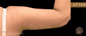 After Image: Case #6630 – Arm lift with SAFELipo sculpting