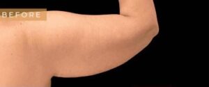Before Image: Case #6630 – Arm lift with SAFELipo sculpting