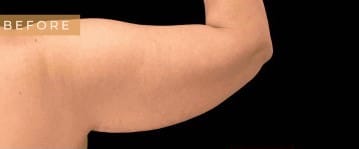 Before Image: Case #6630 – Arm lift with SAFELipo sculpting - back