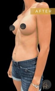 After Image: Case #6638 – Breast augmentation with gel implants - left-front-oblique