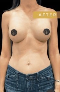 After Image: Case #6638 – Breast augmentation with gel implants - front
