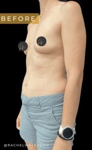 Before Image: Case #6638 – Breast augmentation with gel implants - left-front-oblique