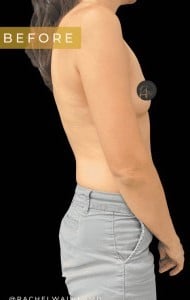 Before Image: Case #6638 – Breast augmentation with gel implants - right-side