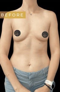 Before Image: Case #6638 – Breast augmentation with gel implants - front