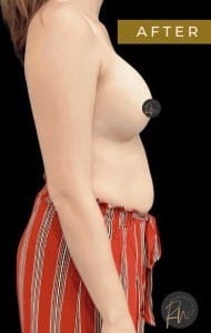 After Image: Breast and Breast Augmentation - right-side