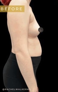 Before Image: Breast and Breast Augmentation - right-side