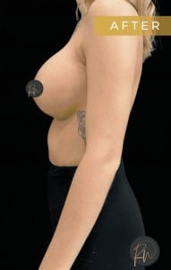After Image: Case #6754 – Breast Augmentation - left-side
