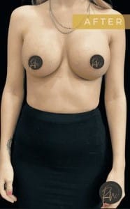 After Image: Case #6754 – Breast Augmentation - front