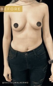 Before Image: Case #6754 – Breast Augmentation - front