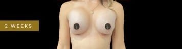 Before Image: Case #7064 – Breast Augmentation - front