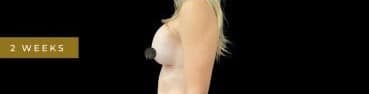 Before Image: Case #7064 – Breast Augmentation - left-side