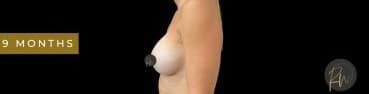 After Image: Case #7064 – Breast Augmentation - left-side