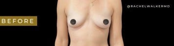 Before Image: Case #7064 – Breast Augmentation - 