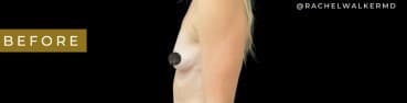 Before Image: Case #7064 – Breast Augmentation - left-side