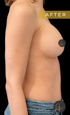 After Image: Case #7090 – Breast Augmentation - right-side