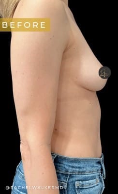 Before Image: Case #7090 – Breast Augmentation - right-side