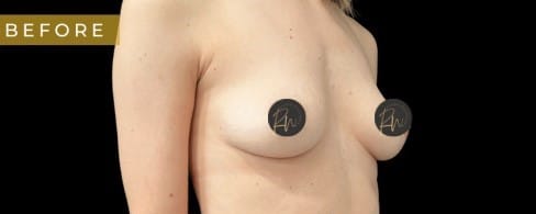 Before Image: Case #7090 – Breast Augmentation - right-front-oblique