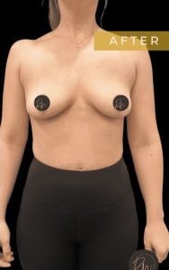 After Image: Case #6758 Breast Implant Removal - front