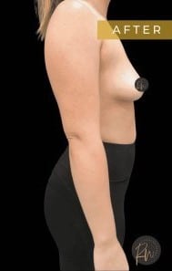 After Image: Case #6758 Breast Implant Removal - right-side