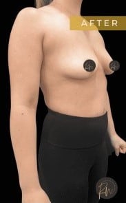 After Image: Case #6758 Breast Implant Removal - right-front-oblique