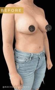 Before Image: Case #6758 Breast Implant Removal - right-front-oblique