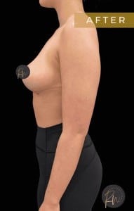 After Image: Case #6763- Breast Reduction - left-side