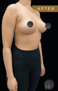 After Image: Case #6763- Breast Reduction - right-front-oblique