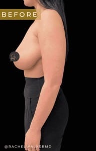 Before Image: Case #6763- Breast Reduction - left-side