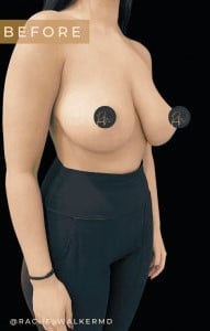 Before Image: Case #6763- Breast Reduction - right-front-oblique