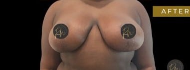 After Image: Case #6767 Breast Reduction with SAFElipo of braline - front