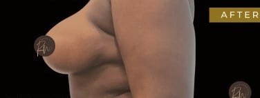 After Image: Case #6767 Breast Reduction with SAFElipo of braline - left-side