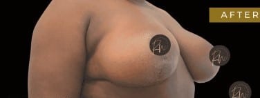 After Image: Case #6767 Breast Reduction with SAFElipo of braline - right-front-oblique