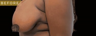 Before Image: Case #6767 Breast Reduction with SAFElipo of braline - left-side