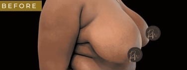 Before Image: Case #6767 Breast Reduction with SAFElipo of braline - right-front-oblique