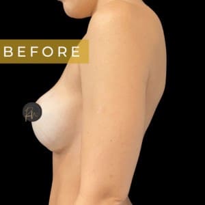 Before Image: Case #7068 – Breast Pocket Revision with Galaflex - left-side