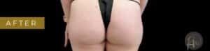 After Image: Case #6877 – Cellulite