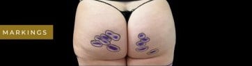 Before Image: Case #7056 – Aveli Cellulite Treatment - back