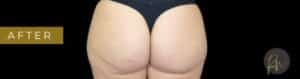 After Image: Case #7056 – Aveli Cellulite Treatment