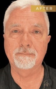 After Image: Case #6773 – Facial surgery and Eyelid surgery - front