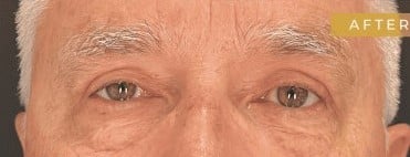 After Image: Case #6773 – Facial surgery and Eyelid surgery - front