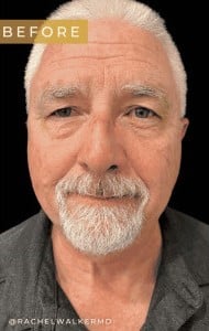 Before Image: Case #6773 – Facial surgery and Eyelid surgery - front
