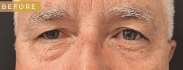 Before Image: Case #6773 – Facial surgery and Eyelid surgery - front