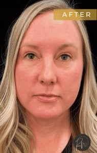 After Image: Case #6778 – Upper and Lower Blepharoplasty - front