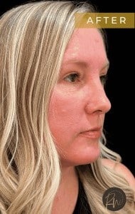After Image: Case #6778 – Upper and Lower Blepharoplasty - right-front-oblique