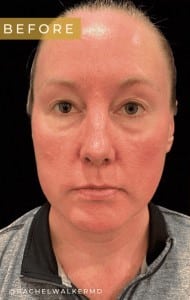 Before Image: Case #6778 – Upper and Lower Blepharoplasty - front