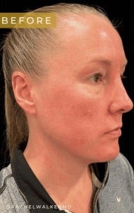 Before Image: Case #6778 – Upper and Lower Blepharoplasty - right-front-oblique