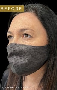 Before Image: Case #6783 –  facial and eyelid surgery - left-front-oblique