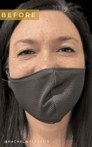 Before Image: Case #6783 –  facial and eyelid surgery - front
