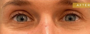 After Image: Case #7048 – Eyelid Surgery - front